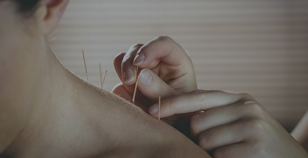 acupuntura